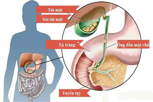 Chữa sỏi mật