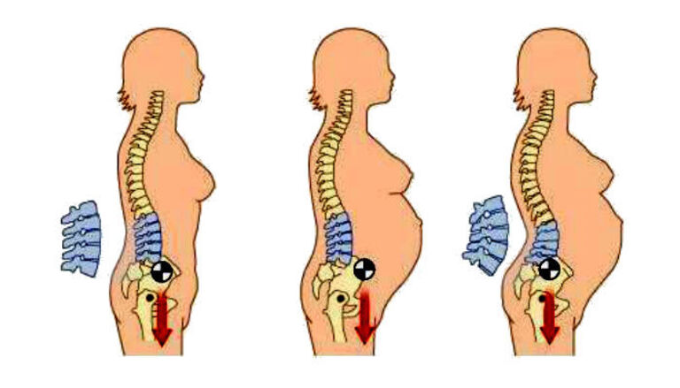 Sự thay đổi hình dạng cột sống khi mang thai là một trong những nguyên nhân sinh lý phổ biến gây đau.