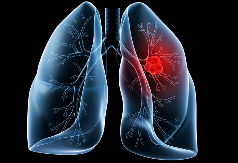 Ung thư phổi gây đau nhói sau lưng trên bên phải và bên trái