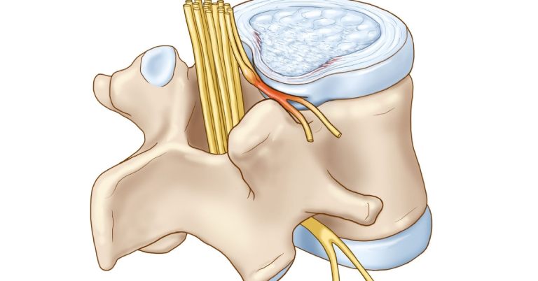 Khi các dây thần kinh cột sống bị chèn ép lâu ngày sẽ ảnh hưởng nghiêm trọng đến sức khỏe người bệnh