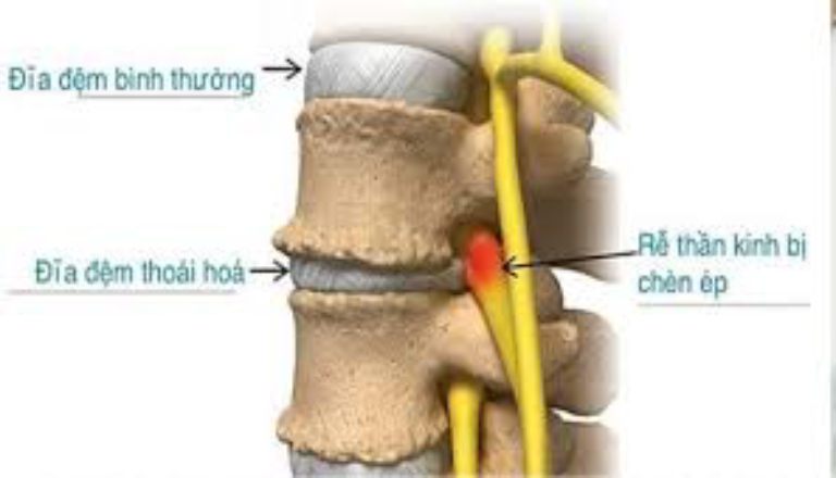 Thoái hóa đĩa đệm được xem là nguyên nhân hàng đầu gây đau ở rễ thần kinh cột sống