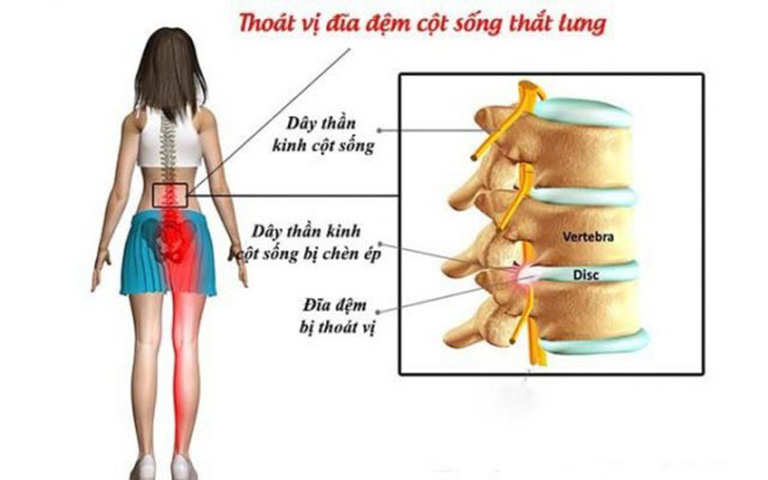 Đau thắt lưng ở phụ nữ là triệu chứng thường gặp của bệnh thoát vị đĩa đệm
