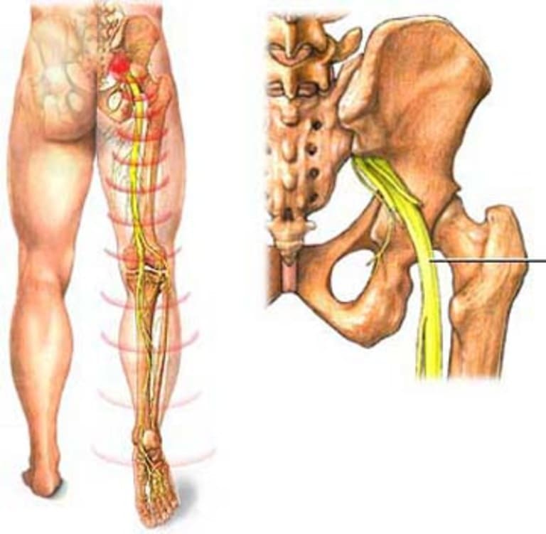 Đau do thần kinh tọa bị chèn ép thường chỉ xuất hiện ở phần mông và chân phải.
