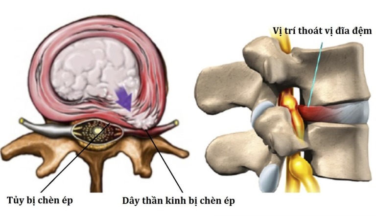 Đau vai gáy kèm buồn nôn nếu có nguyên nhân từ bệnh lý rất dễ dẫn đến bại liệt.