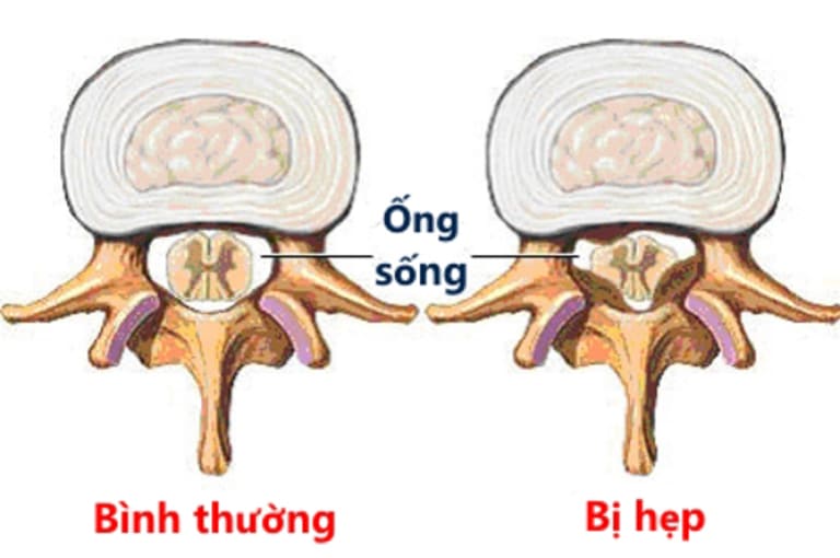 Ống sống bị hẹp khiến dây thần kinh và tủy sống bị chèn ép nên gây ra các cơn đau ở vai gáy và tay.