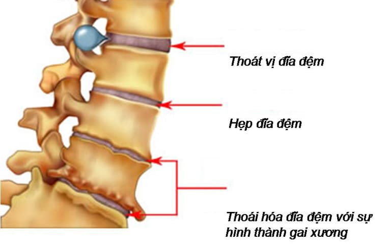 Thoát vị đĩa đệm cột sống cổ là nguyên nhân phổ biến gây ra các cơn đau từ vai gáy lan ra cánh tay.