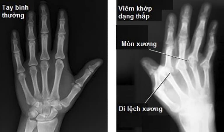 Thông thường, viêm khớp dạng thấp chỉ thể hiện rõ các thương tổn của các khớp trên hình ảnh X - quang khi bệnh đã nặng.