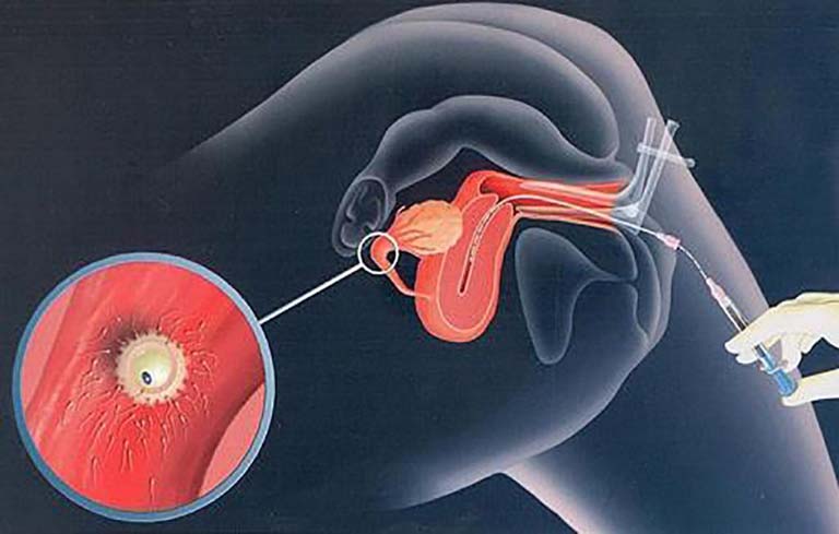 Mang thai nhờ phương pháp bơm tinh trùng vào buồng tử cung