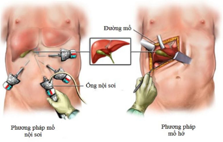 Mổ sỏi mật