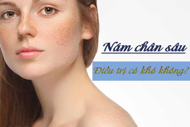 Nám chân sâu