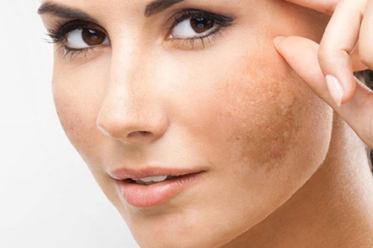 Cách trị nám da mặt
