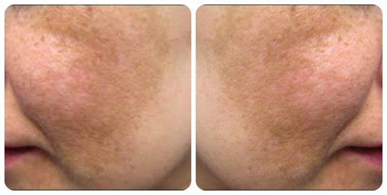 Nám mảng thường tập trung thành mảng lớn trên da mặt