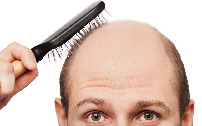 Hói đầu là một dạng rối loạn gây rụng tóc thường gặp ở cả nam và nữ