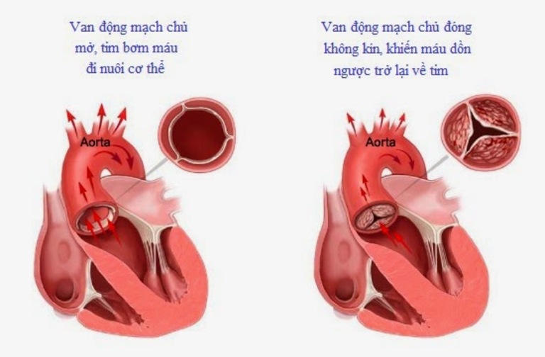 Máu lưu thông chậm do hoạt động co bóp của tim bị suy giảm sẽ gây sung huyết ở phổi và những cơn ho khan