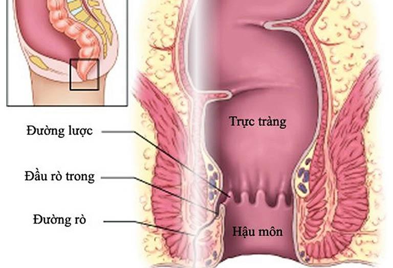 Phân loại rò hậu môn