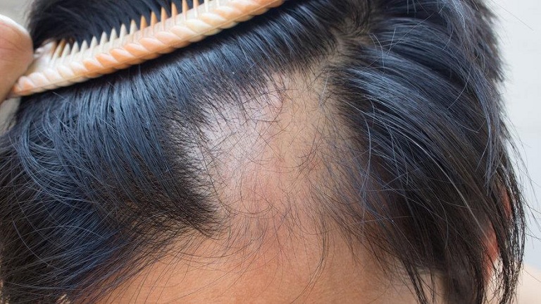 Rụng tóc là tình trạng thường gặp ở phụ nữ sau sinh nở