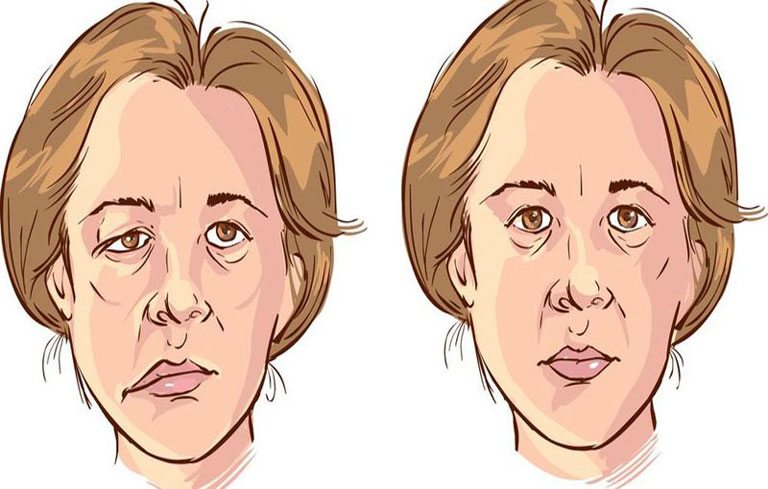 Méo miệng liệt mặt là một trong những dấu hiệu thường gặp ở bệnh nhân tai biến mạch máu não
