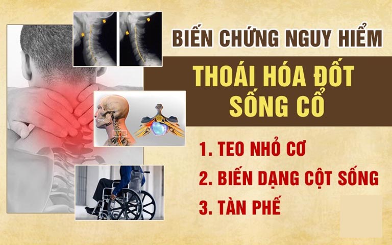 Biến chứng thoái hóa cột sống cổ