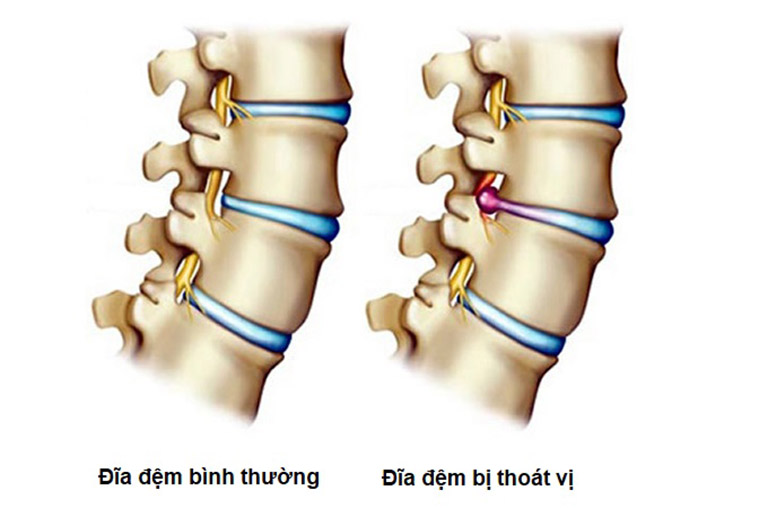 Thoát vị đĩa đệm là một trong những nguyên nhân gây đau lưng sau khi ngủ dậy