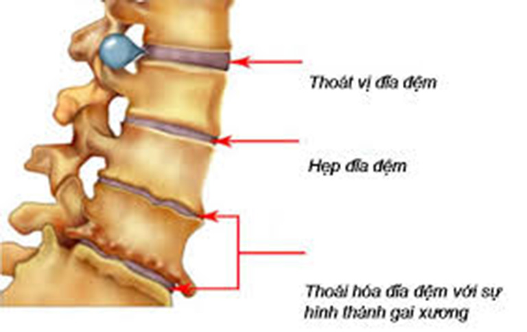 Đau vùng thắt lưng có thể là triệu chứng của bệnh thoát vị đĩa đệm