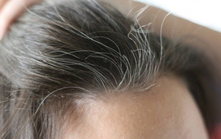 Tóc bạc sớm
