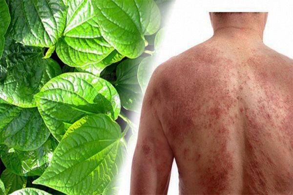 Chữa viêm da cơ địa bằng trầu không