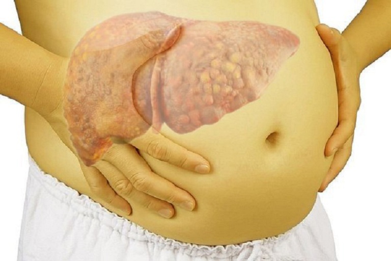 Xơ gan cổ trương giai đoạn cuối