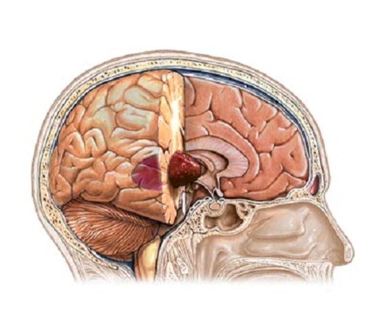 U não hố sau là bệnh lý rất nguy hiểm gây đau vai gáy ở trẻ em.