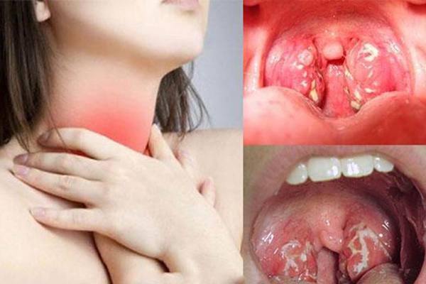 Viêm amidan có chữa được không
