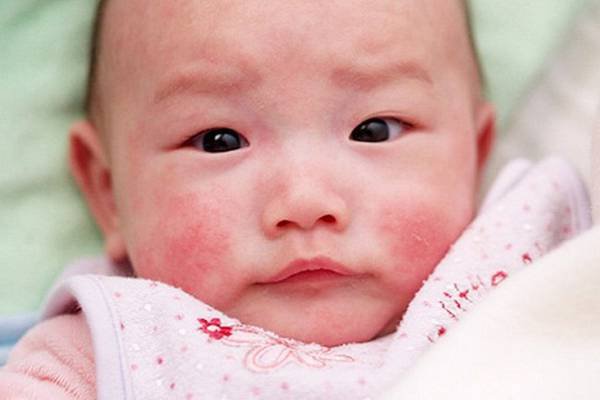 Viêm da cơ địa ở trẻ sơ sinh
