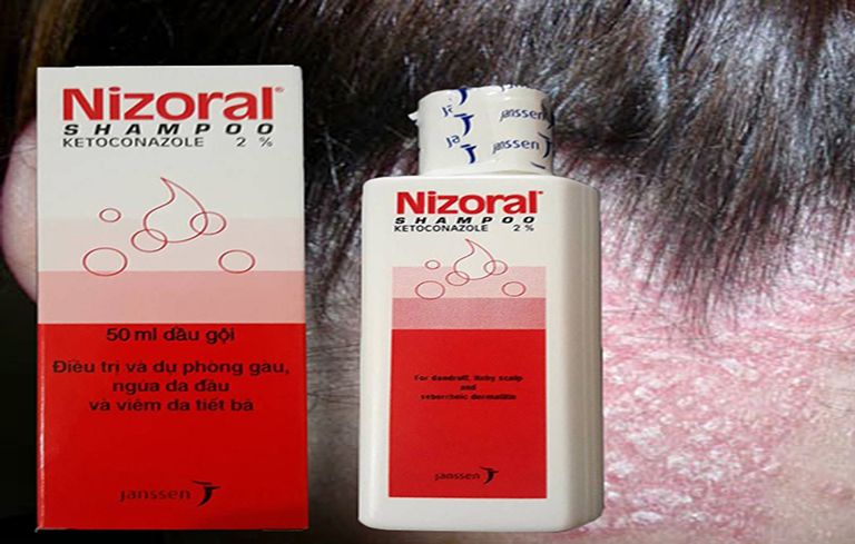 Một số loại dầu gội được sử dụng để trị viêm da dầu da đầu 