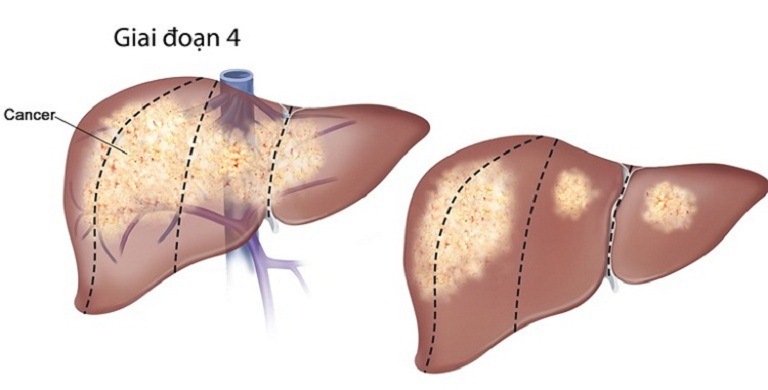 Giai đoạn 4 chức năng gan suy giảm hoàn toàn, dường như không có khả năng phục hồi