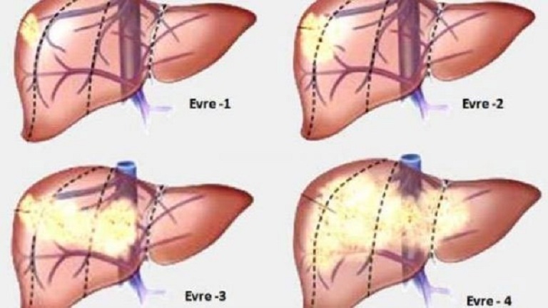 Biểu hiện xơ gan cổ trướng
