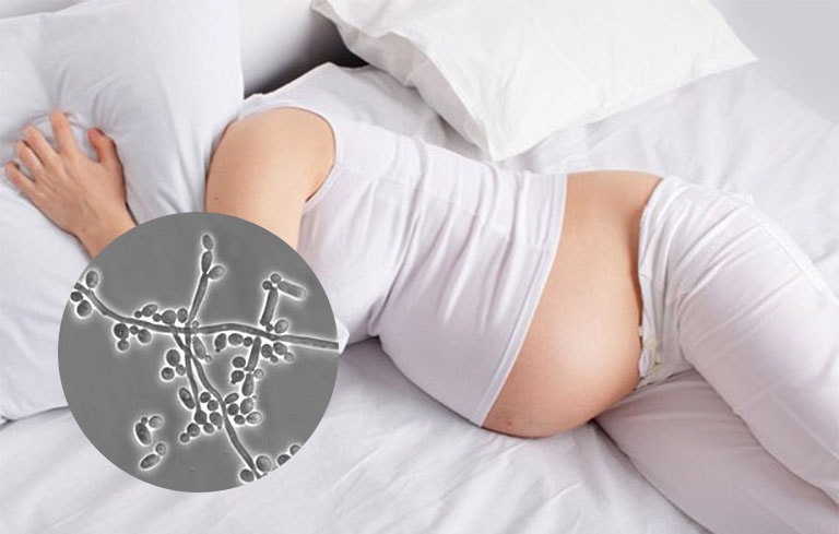 Nấm candida khi mang thai và những câu hỏi thường gặp về bệnh