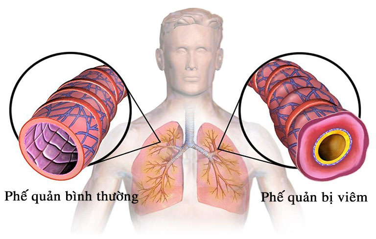 Viêm phế quản là một tình trạng viêm nhiễm đường hô hấp tiềm ẩn nhiều rủi ro