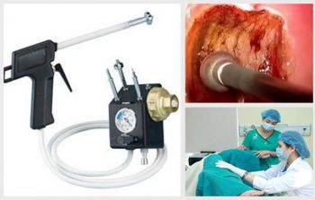 Áp lạnh chữa viêm lộ tuyến cổ tử cung là phương pháp mang lại hiệu quả điều trị bệnh nhanh chóng