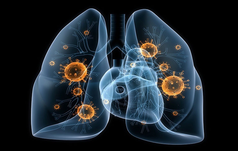 Áp xe phổi đa phần xuất phát từ việc phổi bị nhiễm vi khuẩn, nấm, ký sinh trùng