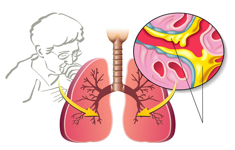 Những trường hợp nặng, mủ gây ảnh hưởng nghiêm trọng có thể cần sự can thiệp của các phương pháp chọc, hút mủ