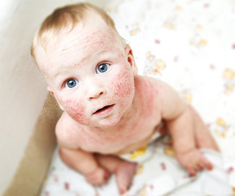 Bệnh chàm sữa là một trong những bệnh ngoài da thường gặp ở trẻ sơ sinh và trẻ nhỏ