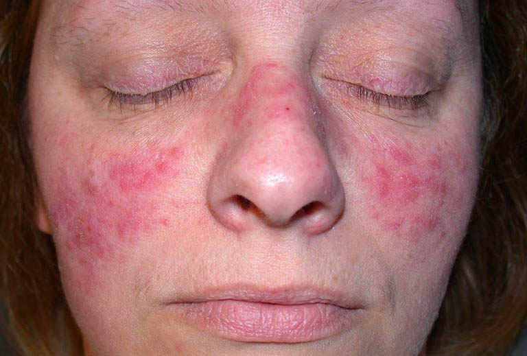 Nguyên nhân gây bệnh Lupus ban đỏ