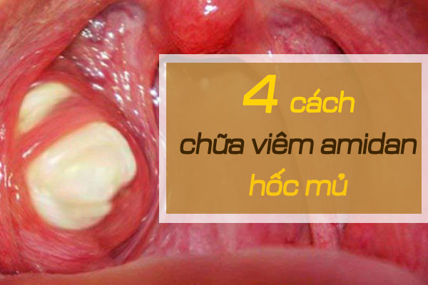 Cách chữa viêm amidan hốc mủ