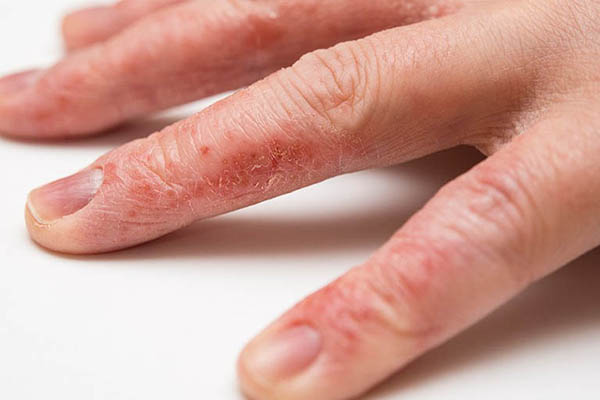 Bệnh chàm khô đầu ngón tay
