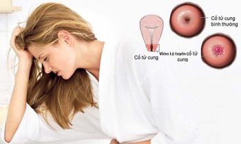 Chi phí chữa viêm lộ tuyến cổ tử cung rất khó xác định bởi phụ thuộc vào nhiều yếu tố