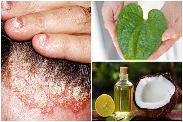 Chữa vảy nến bằng phương pháp dân gian