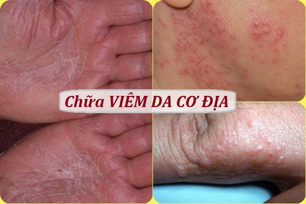 Chữa viêm da cơ địa