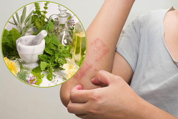 Điều trị viêm da cơ địa bằng lá cây