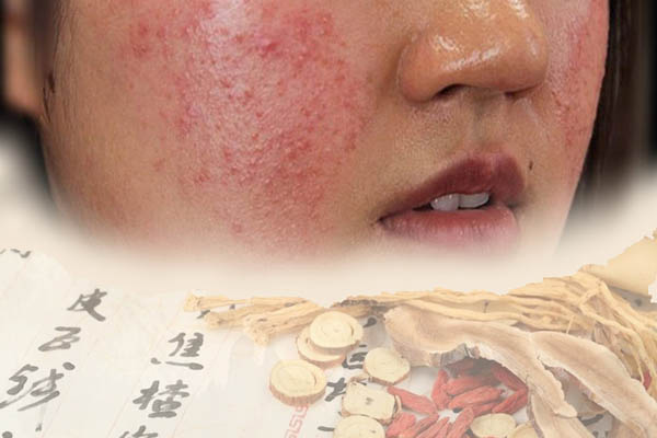 Chữa viêm da tiết bã (viêm da dầu)