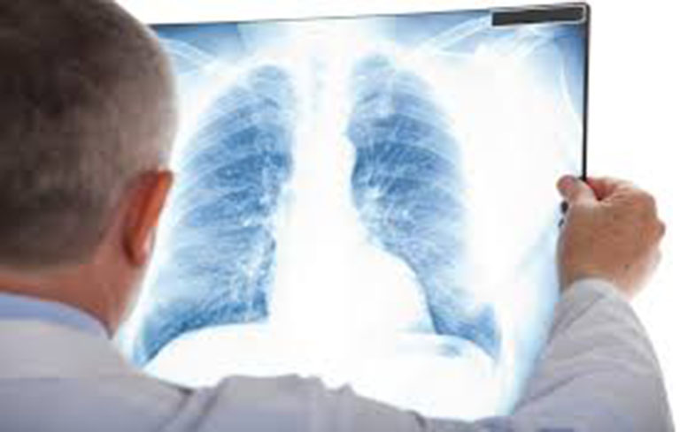 Chụp X-quang là phương pháp chẩn đoán chính xác nhất tình trạng áp xe phổi