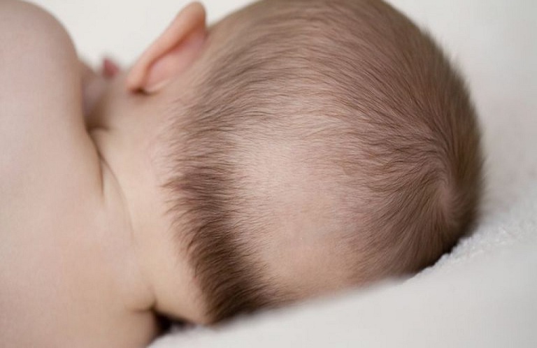 Rụng tóc có thể do tư thế ngủ của bé