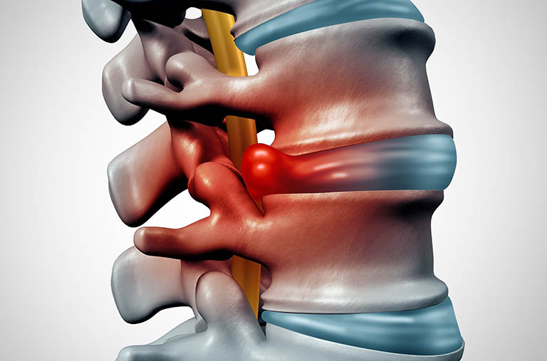 Thoát vị đĩa đệm cột sống thắt lưng